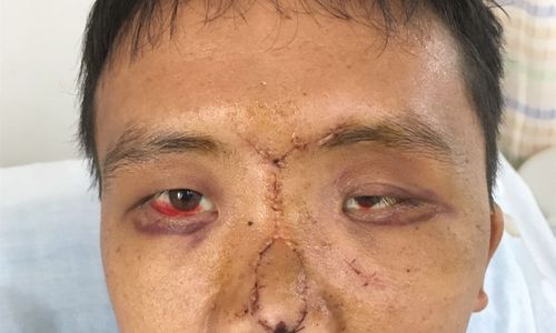小伙车祸至左眼失明,紧急手术挽救视力.