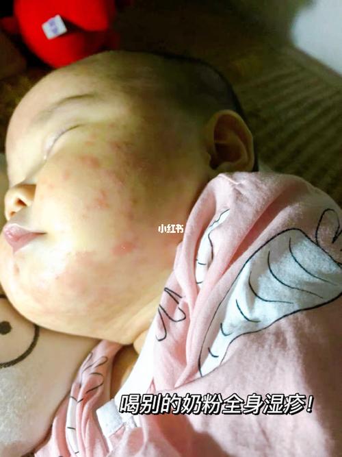 家有牛奶蛋白过敏宝宝……一度让我崩溃_过敏_奶粉_后