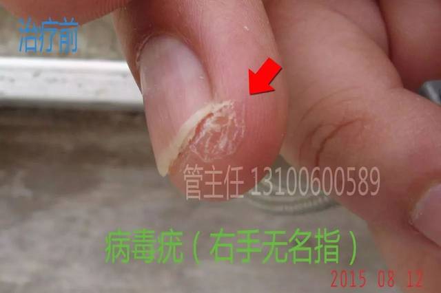 这就是俗话说的"猴子",学名:病毒疣.