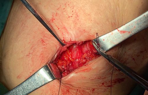 腹腔镜小切口腹壁切口疝腹膜前补片修补术(emilos)术者:沈雄飞,苟扬