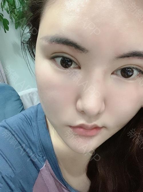 切眉一年后疤痕图片_凹陷疤痕图片