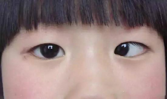 内斜视是一只或者两只眼向里斜.