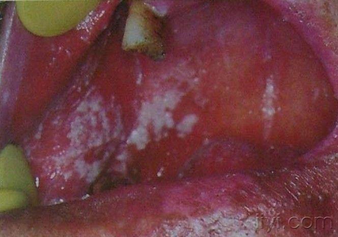 急性假膜性念珠菌病