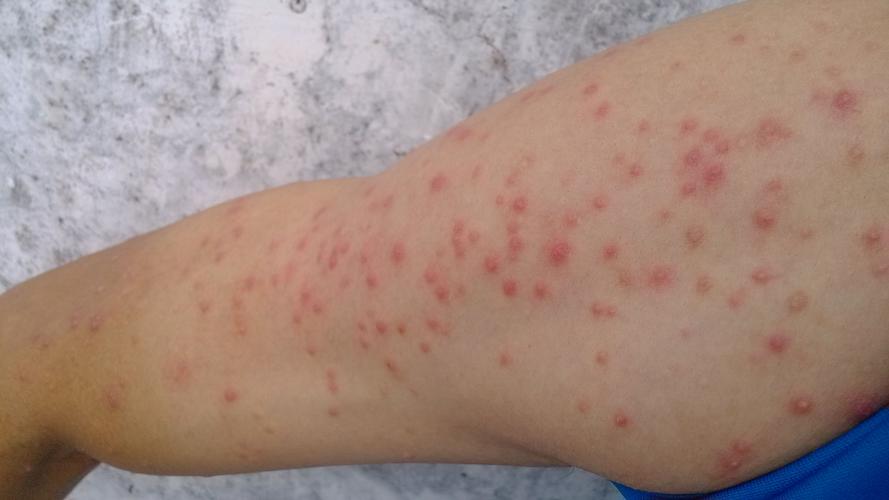 手臂靠肩膀的位置外侧比较多点,长了这么多小红点,请专家来为我解答下