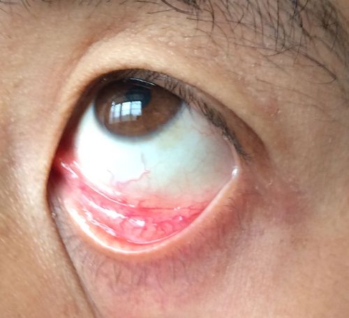 这个是结膜炎吗?有一年多了.平常不痛不痒,血丝比这个