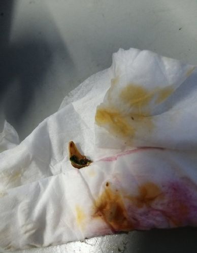 真的很恶心想吐张亮麻辣烫吃出指甲来了