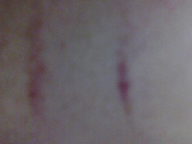 身上有像淤血一样的条状是怎么回事?