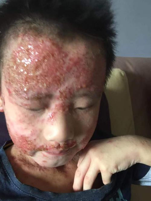 十年湿疹,特应性皮炎.