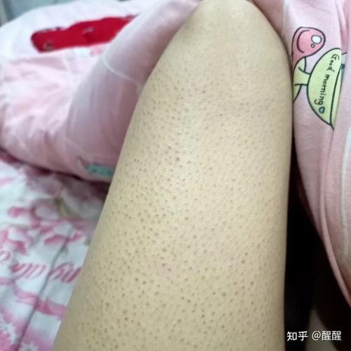 怎么祛除"鸡皮肤"?