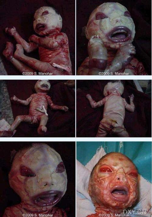 小儿hebra脂溢性鱼鳞病