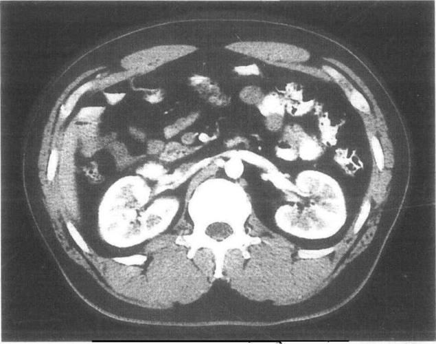 肾脏正常及变异ct图像