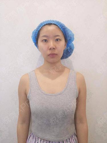 假体隆胸术后323天_隆胸术后323天_胸部整形术后323天_悦mer