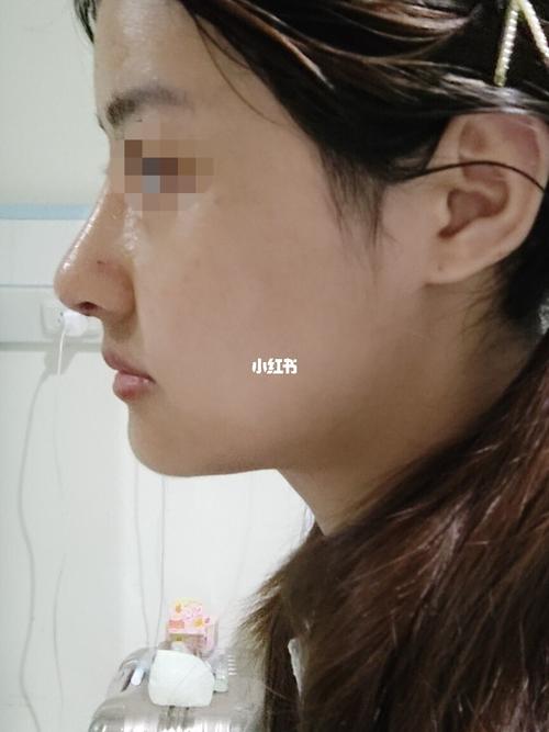 肋骨鼻尖 真皮垫鼻背