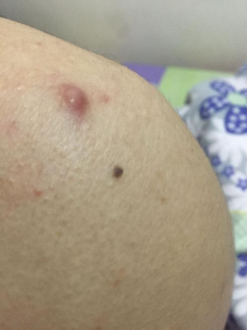 肩膀上这几天长了个硬疙瘩 像痘痘一样 但是不痒不痛