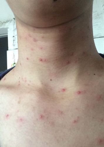 身上只有脖子左右上半身长很多痘痘 用过很多药都没用 去看病都说是