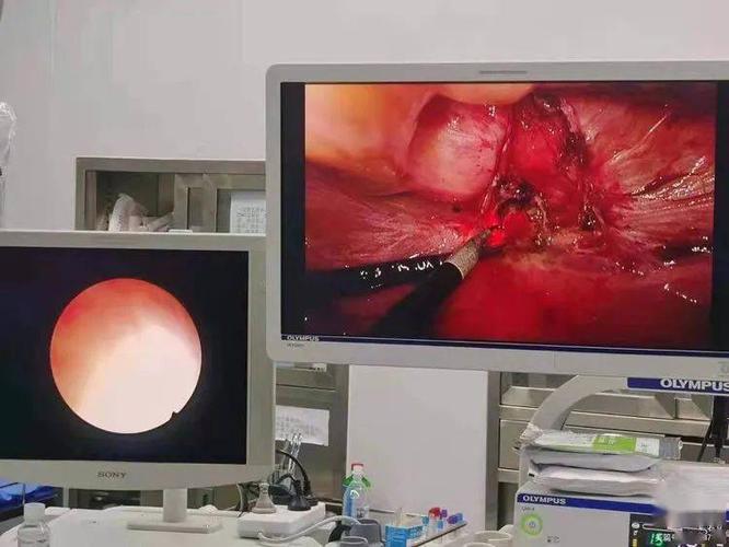 宫腹联合治疗子宫憩室1例