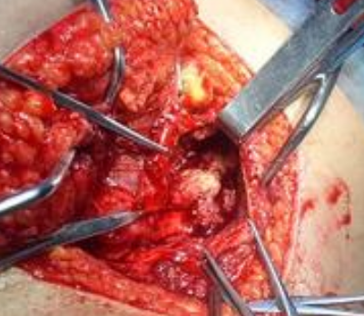 骨癌截肢后的复发率