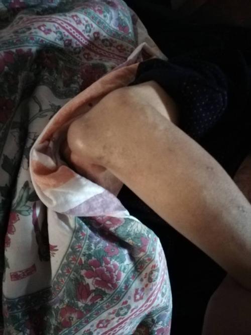 右手肘关节上突然发现一个大包-淋巴瘤之家