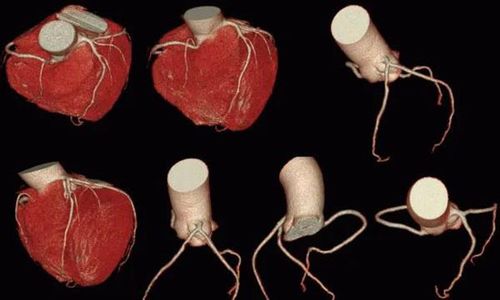 查冠心病为啥不首选冠脉ct?