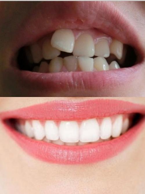 本宝宝牙齿长的也不算太差,就是有一颗门牙长的比较歪_圈子-新氧美容