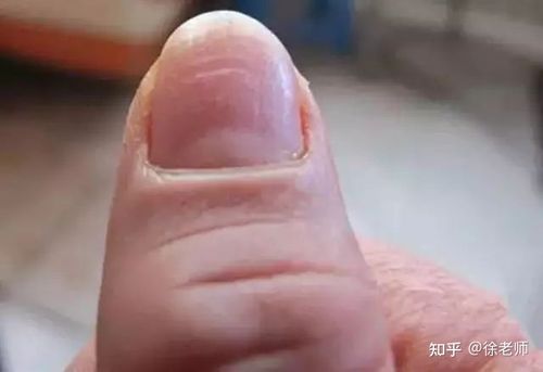 手指甲长这样一定要注意了