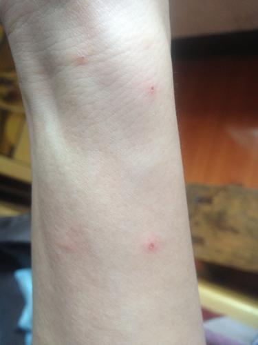 请问大家,这是湿疹还是疥疮啊!