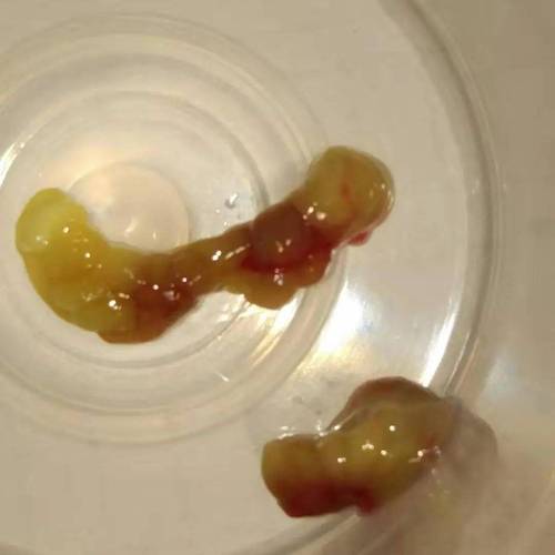 少许肠粘膜样组织排出