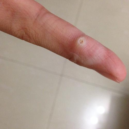手指上的是疣 前两张是一开始的 后面是我去完医院做了急冻的 但我