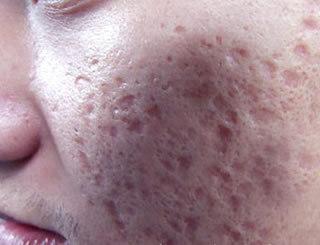 21岁脸上痘坑很严重已有45年现在应该怎么办