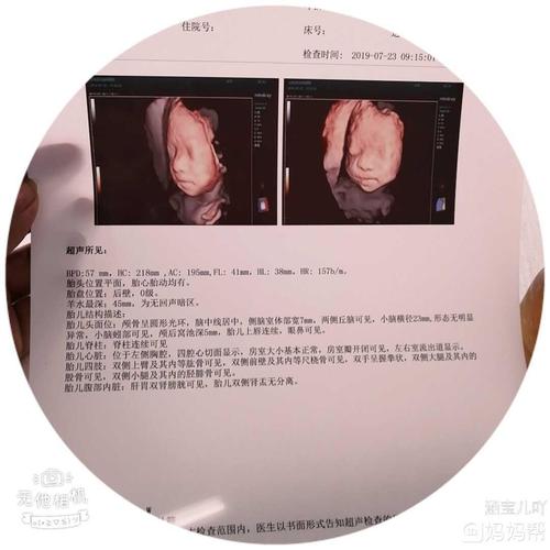 四维彩超出图,怎么看男女?