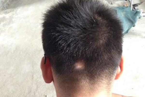 "鬼剃头"到底是怎么一回事?哪些人容易出现?早了解早