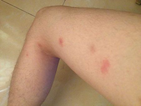 问:这是花柳病吗