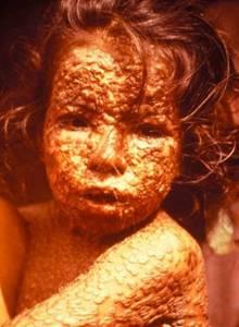 天花病毒的感染症状