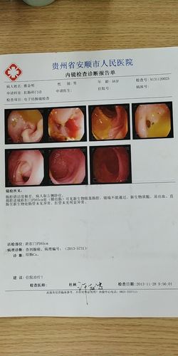 一例"结肠造口还纳术"患者的康复之旅