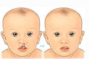 生下兔唇儿的原因