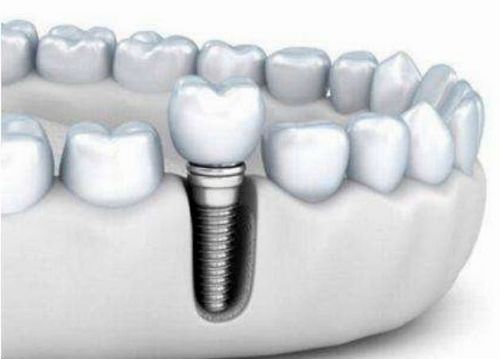在廊坊,种植牙一次能植入几颗?