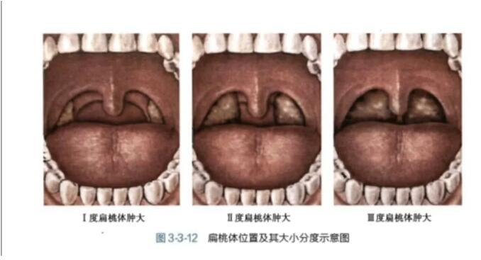 小孩扁桃体肥大饮食要多吃清淡的少吃一些寒凉食物