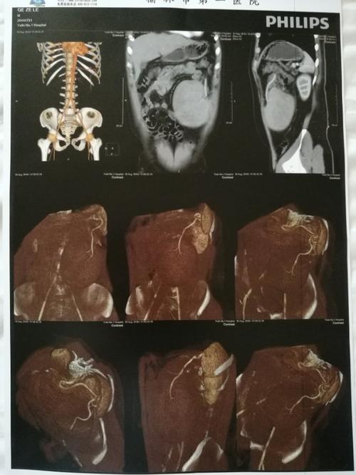 巨大副脾并脾蒂扭转,脾功能亢进一例