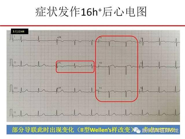 【原创】心电图貌似正常的急性心肌梗死