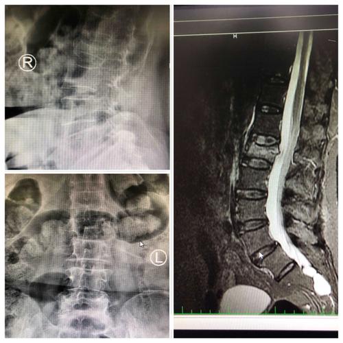 腰椎骨折经皮置钉手术