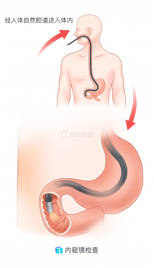 检查胃癌,钡餐还是胃镜?医生揭秘了这3点,看看对比结果你就知道了