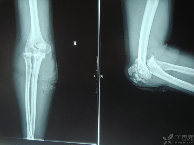 鹰嘴骨折应该选择什么手术方法?