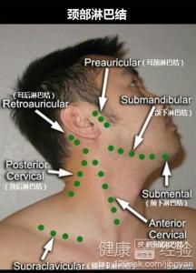 如何进行自我检查淋巴瘤