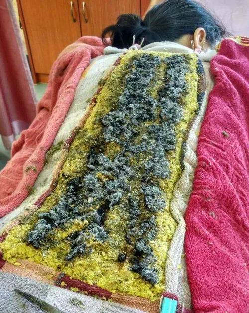 艾灸加姜,疗效无双——隔姜灸