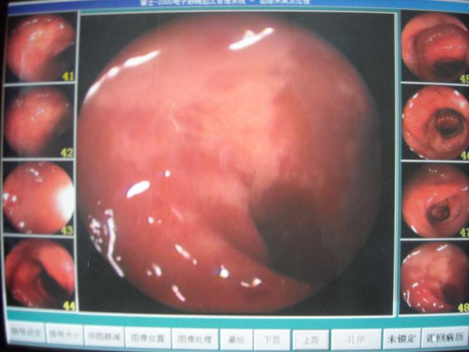 胃镜照片