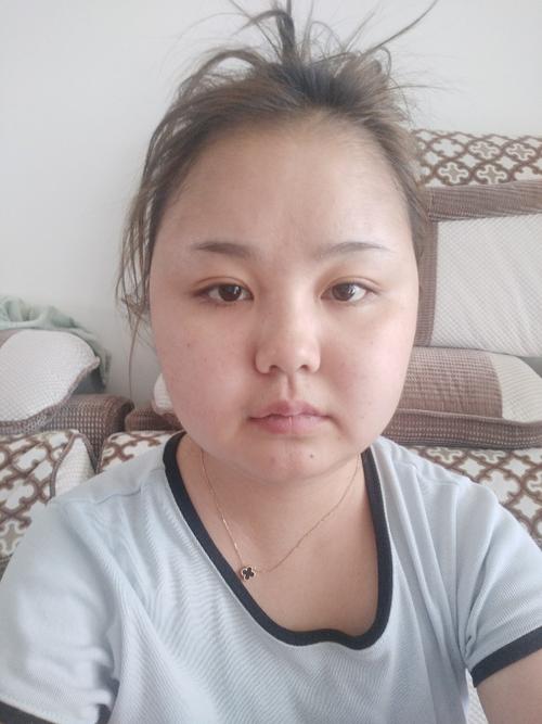 结缔组织病 血小板减少吃激素导致满月脸 水牛背 满脸