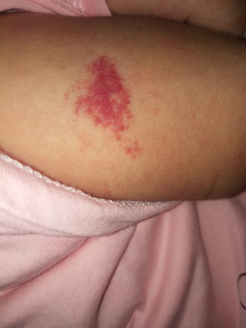 宝宝一个月左右发现胳膊上出现这一片红色,这个是血管瘤吗?