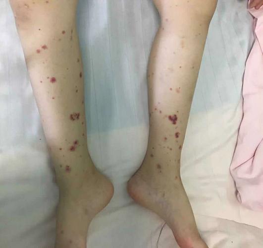 过敏性紫癜皮疹
