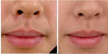 激光脱唇毛对比图