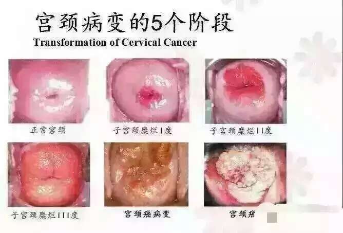 【女性生殖篇】乐活天下妇宝宁可以治好宫颈糜烂吗
